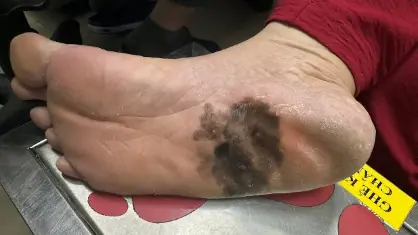 Ung thư tế bào hắc tố ở da: Nhận biết có khó?